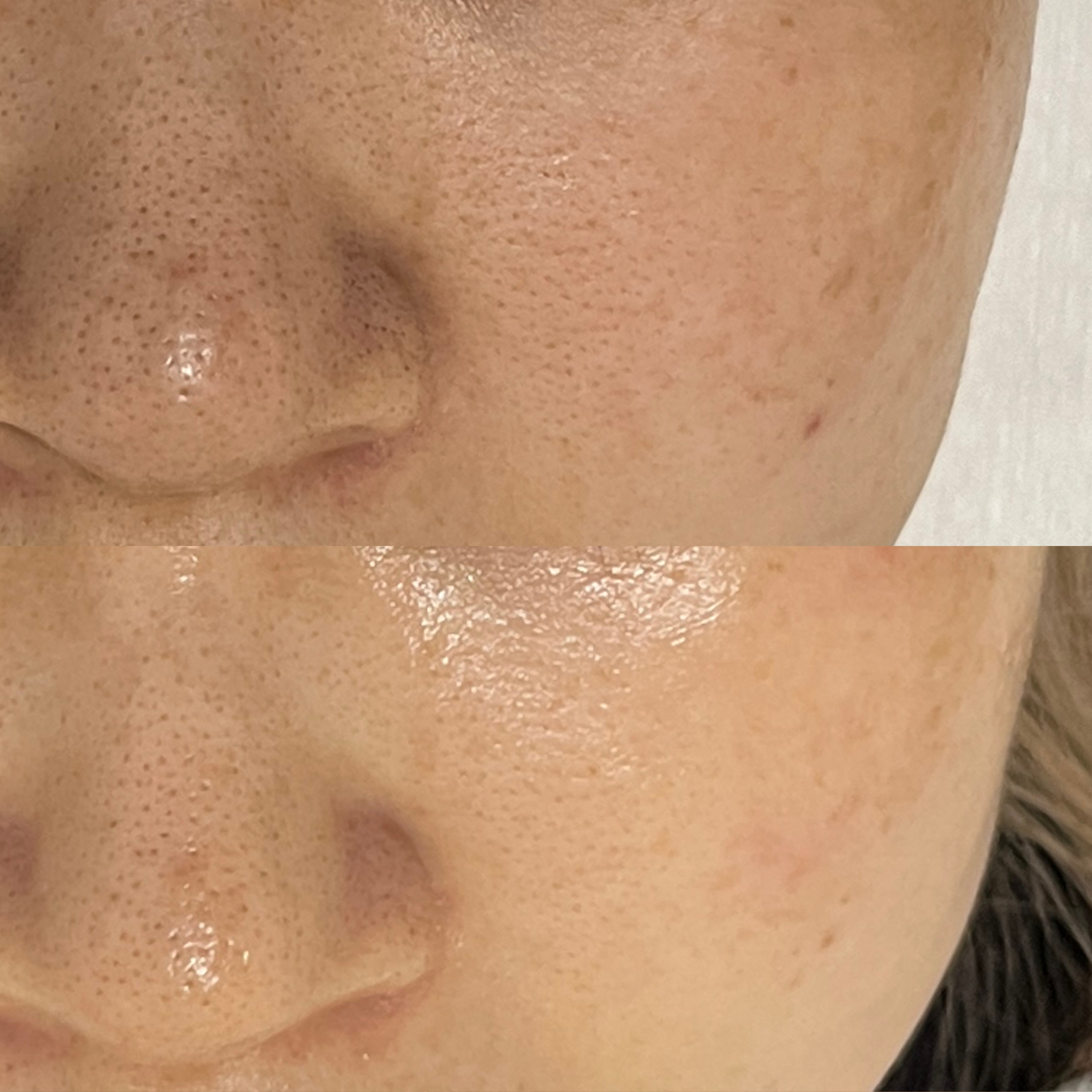 セラピール症例写真1：肌荒れ防止・肌のキメ改善