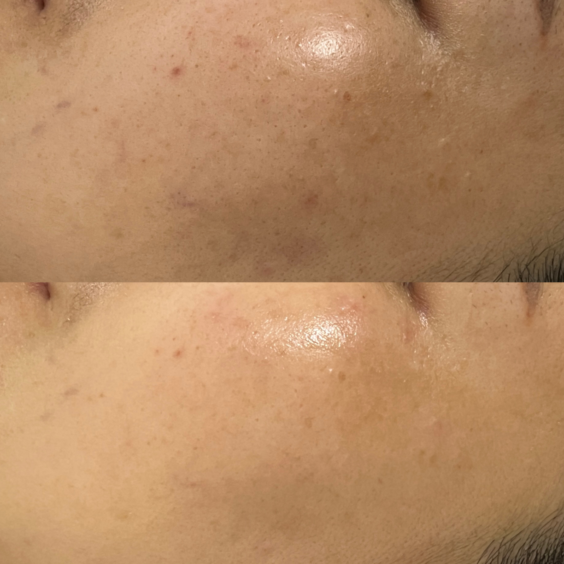 セラピール症例写真2：毛穴改善・シミ防止